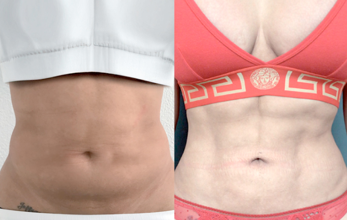 Lipoaspiração - Lipo HD - Clínica FMR