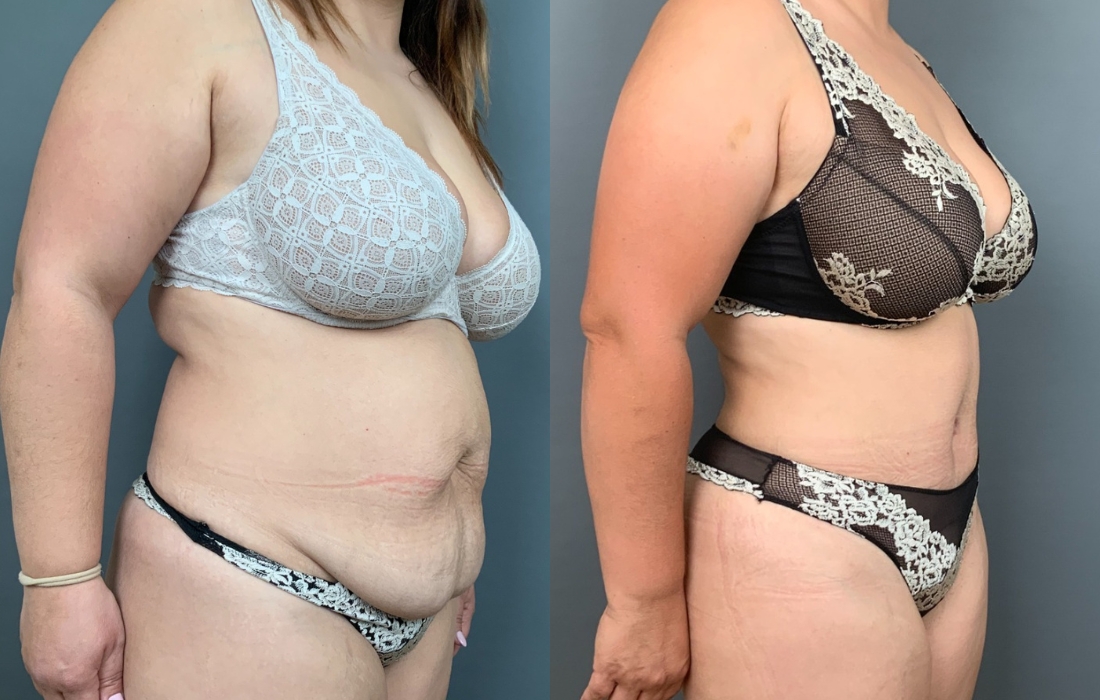 Caso Clínico Abdominoplastia - Clínica FMR