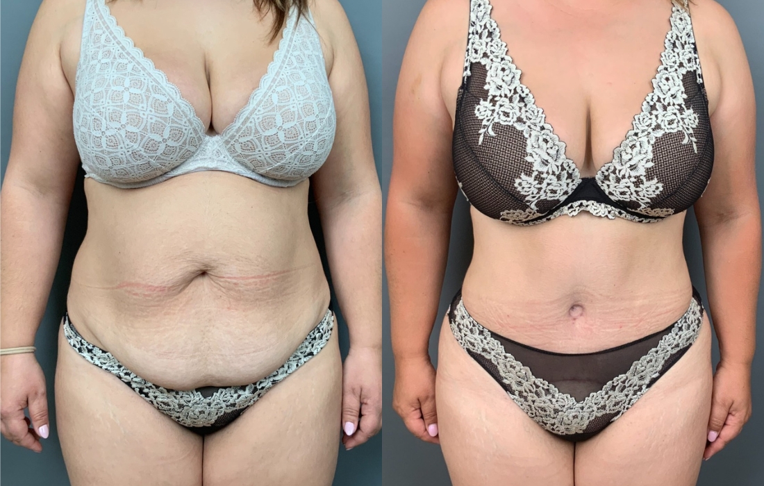 Caso Clínico Abdominoplastia - Clínica FMR