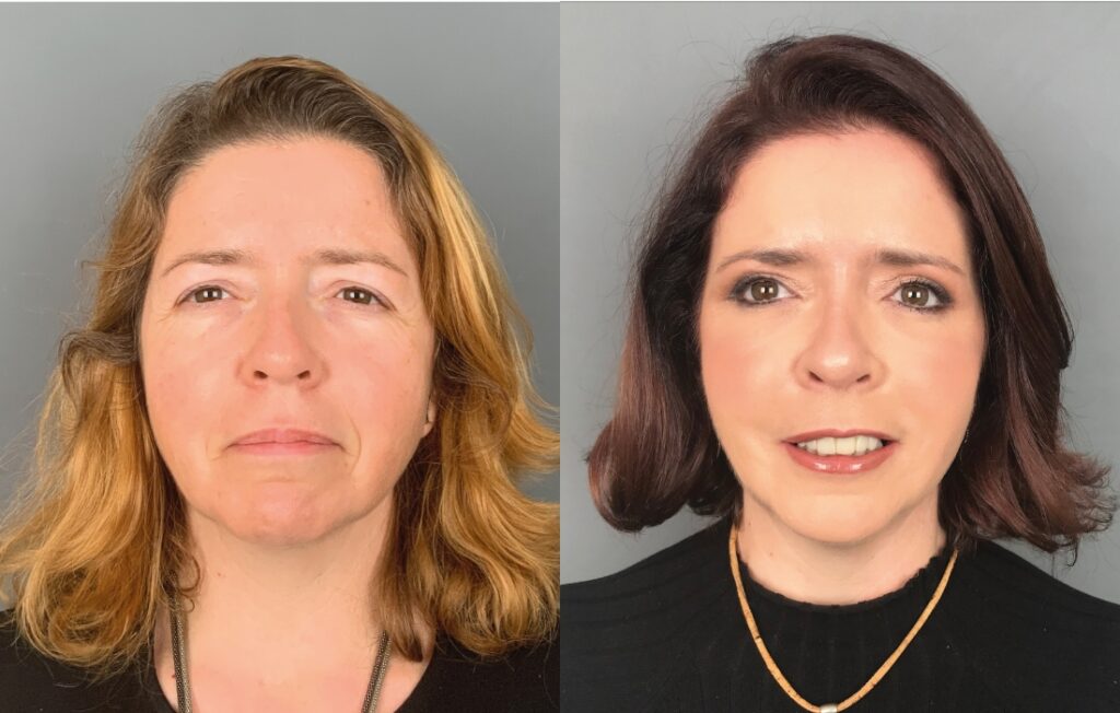 Caso Clínico Necktite - Facetite - Clínica FMR