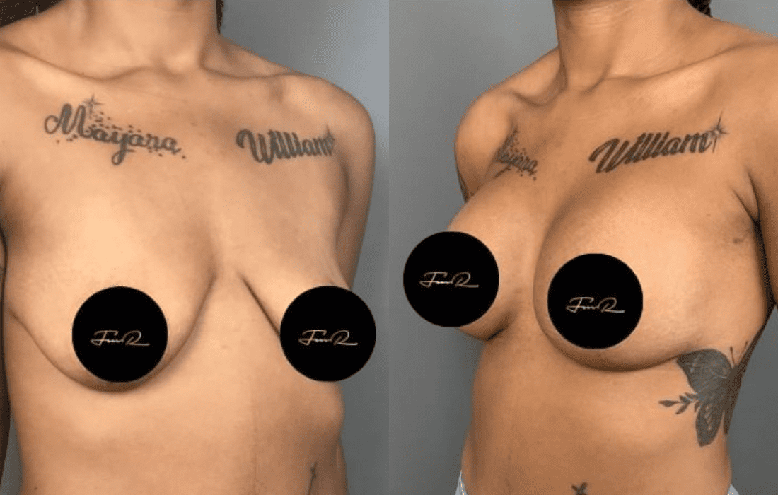 Caso Clínico Mastopexia - Clínica FMR