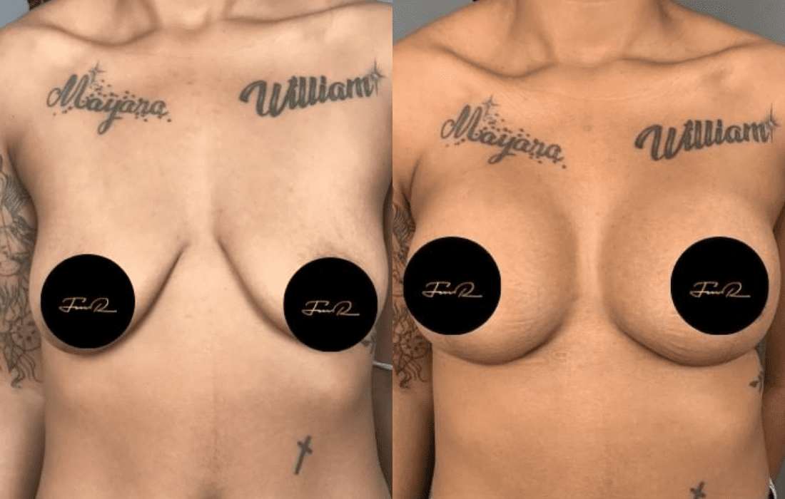 Caso Clínico Mastopexia - Clínica FMR