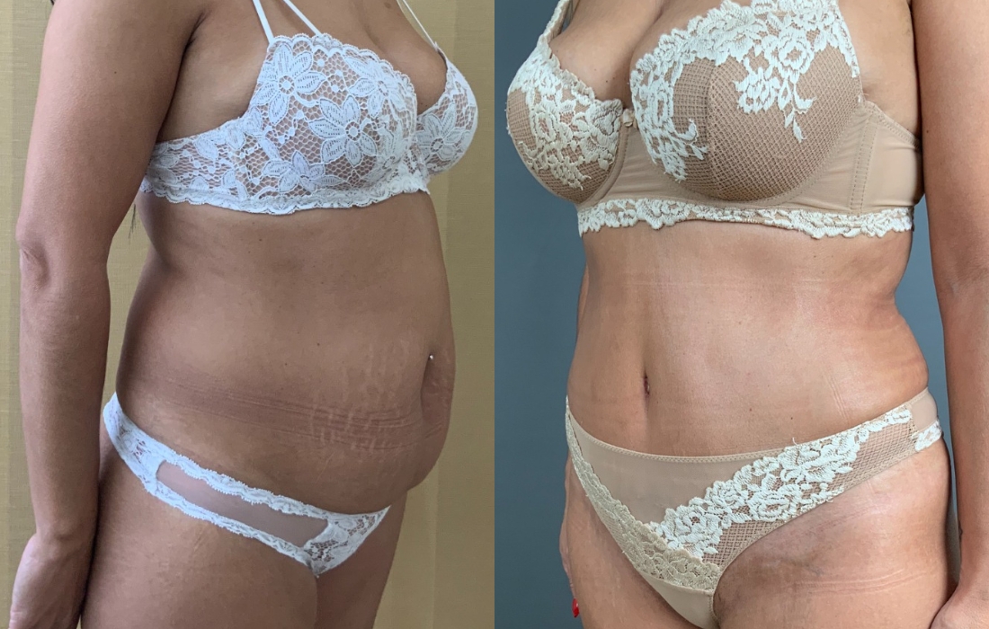 Caso Clínico Abdominoplastia - Clínica FMR