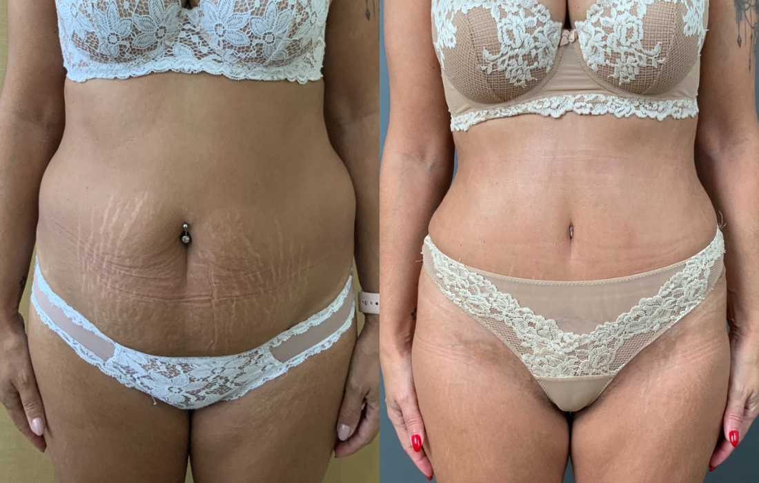 Caso Clínico Abdominoplastia - Clínica FMR