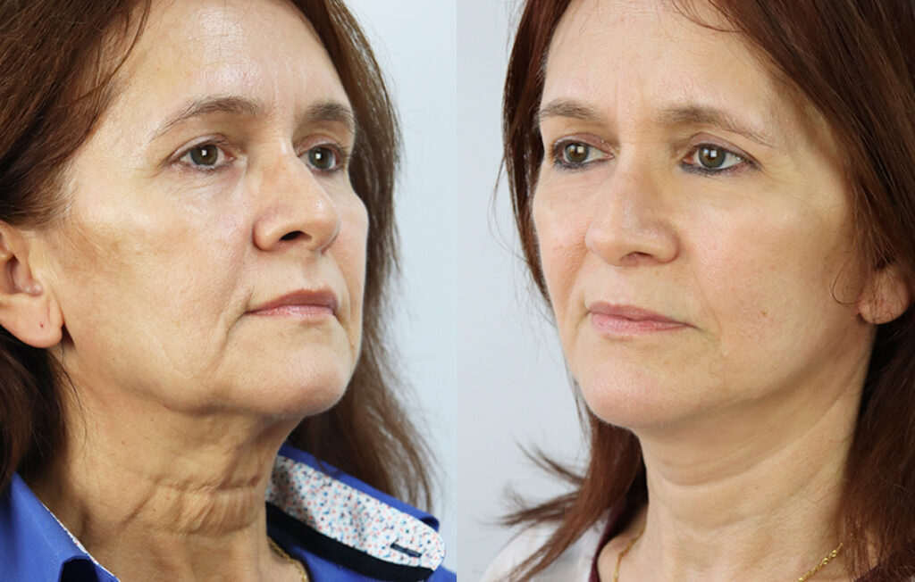 Caso Clínico Lifting Facial - Clínica FMR