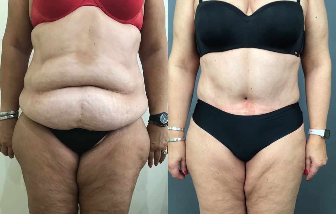 Caso Clínico Abdominoplastia - Clínica FMR