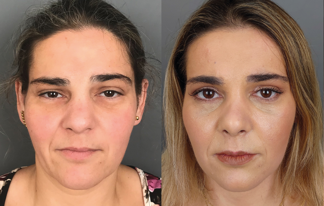 Caso Clínico Blefaroplastia - Clínica FMR