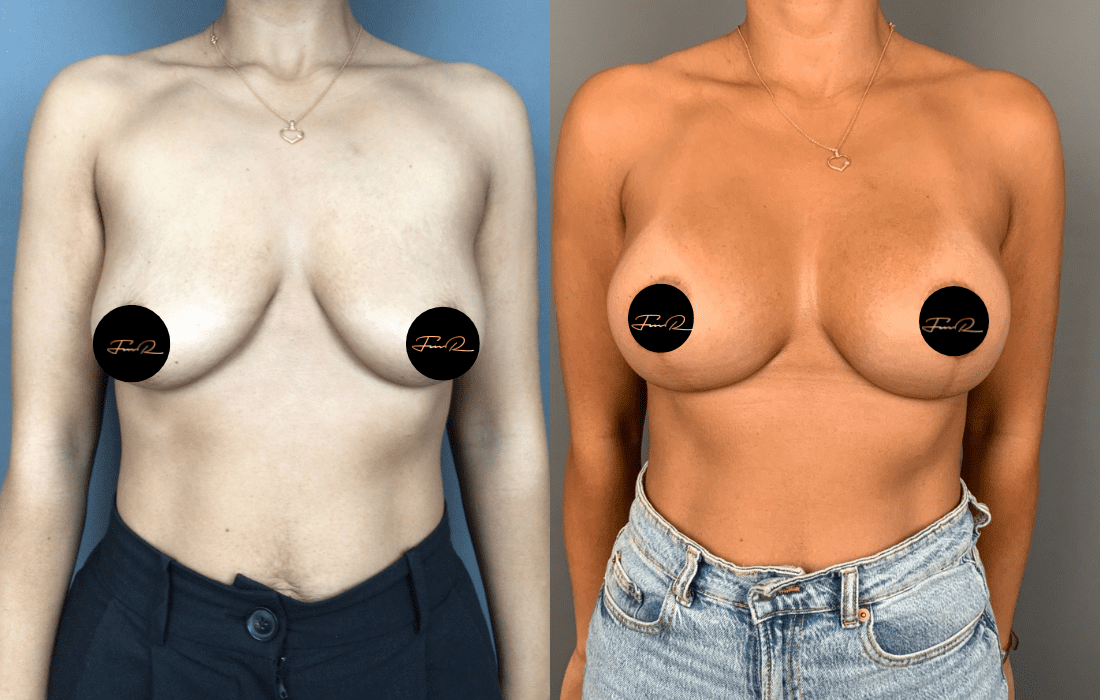 Caso Clínico Mastopexia - Clínica FMR