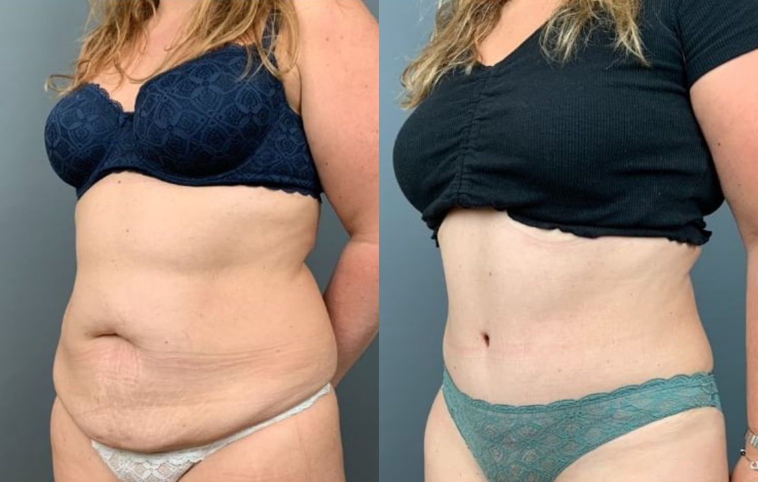 Caso Clínico Abdominoplastia - Clínica FMR