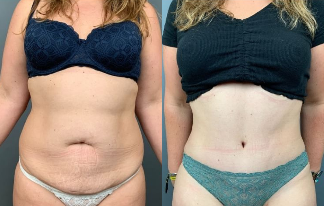 Caso Clínico Abdominoplastia - Clínica FMR