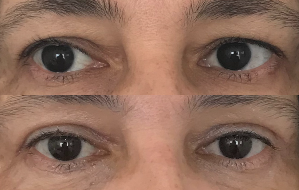 Caso Clínico Blefaroplastia - Clínica FMR