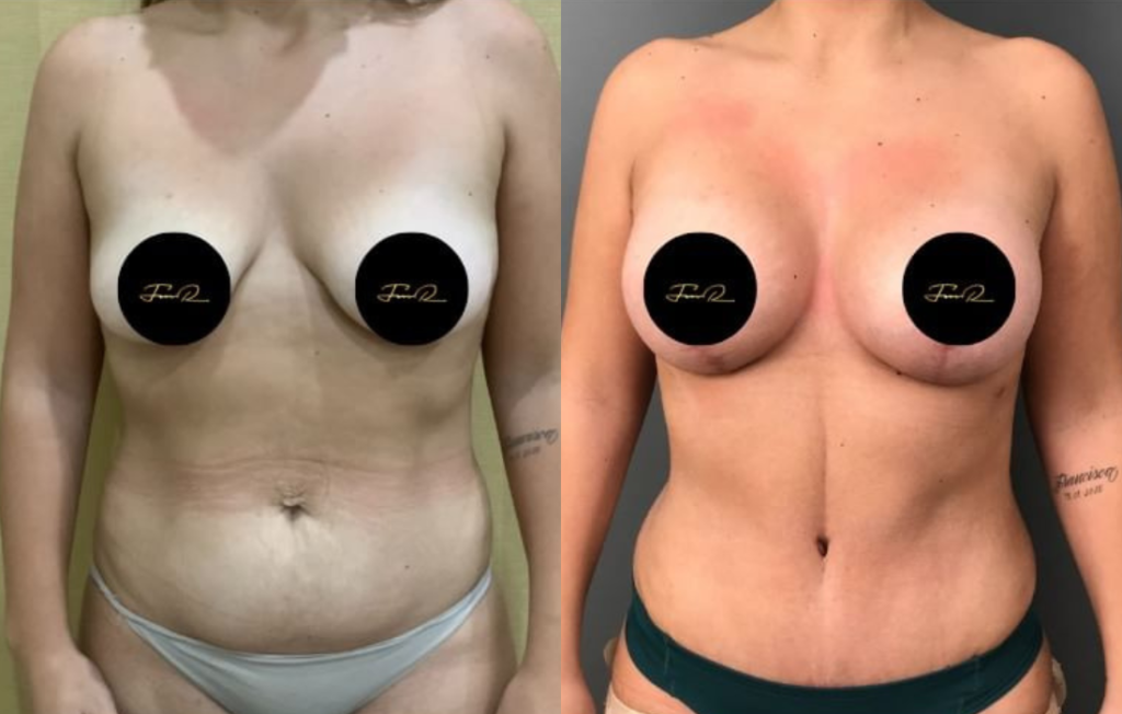 Caso Clínico My Body Back - Clínica FMR