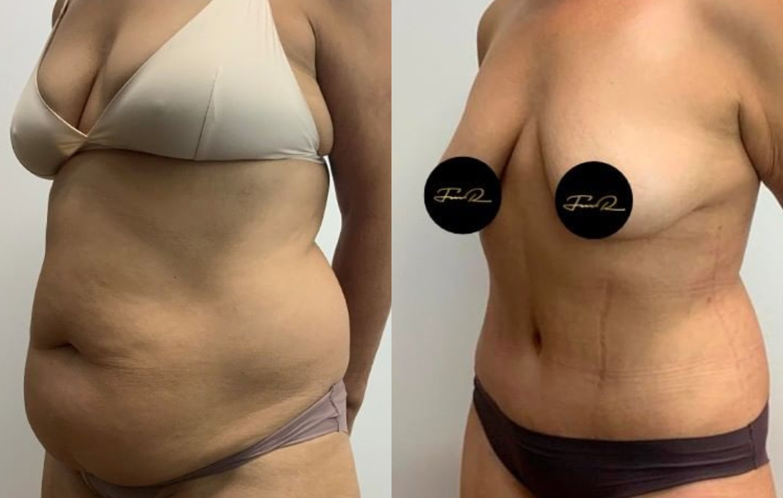 Caso Clínico Abdominoplastia - Clínica FMR