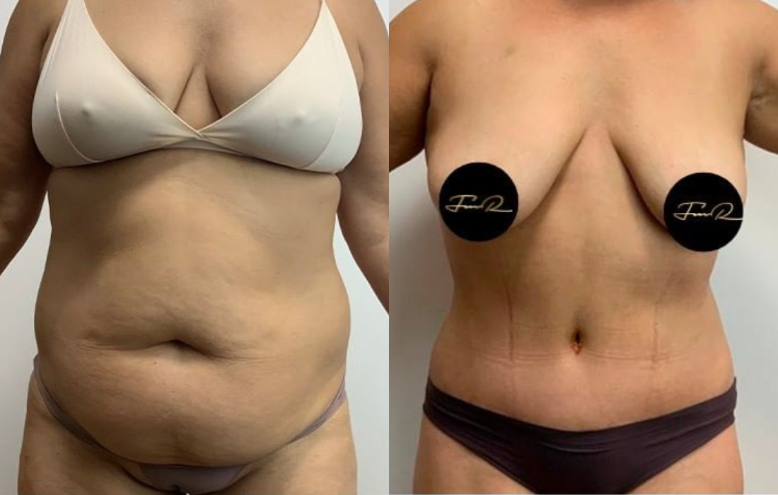 Caso Clínico Abdominoplastia - Clínica FMR