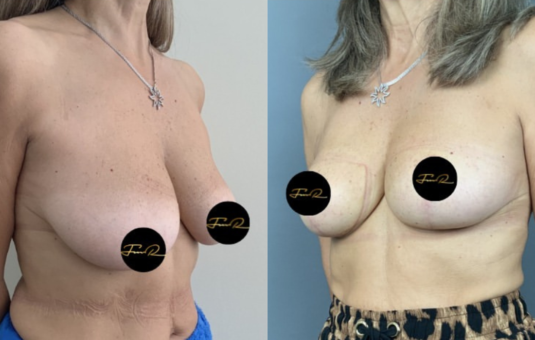Caso Clínico Mamoplastia de Redução - Clínica FMR
