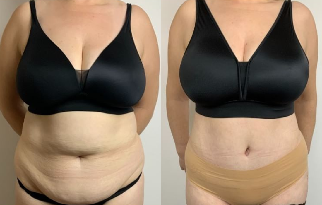 Caso Clínico Abdominoplastia - Clínica FMR