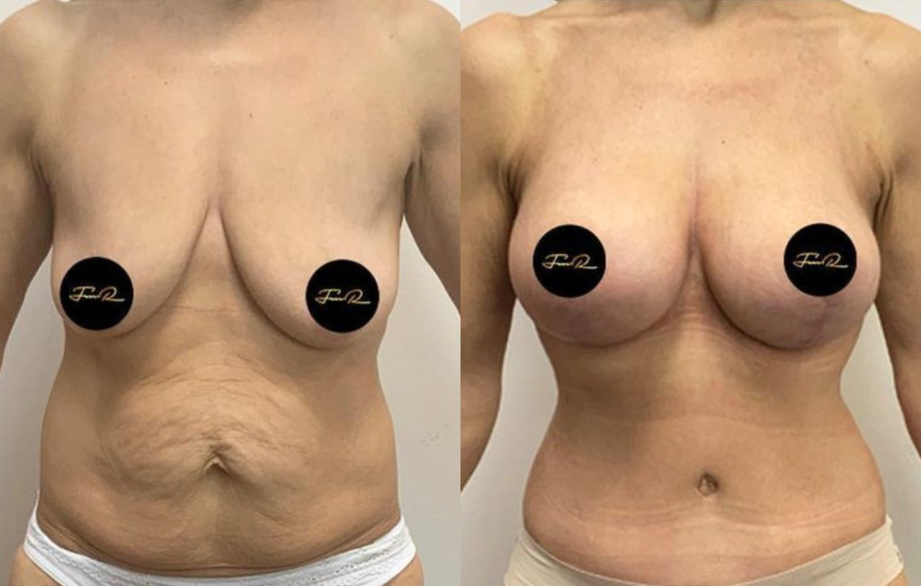 Caso Clínico My Body Back - Clínica FMR