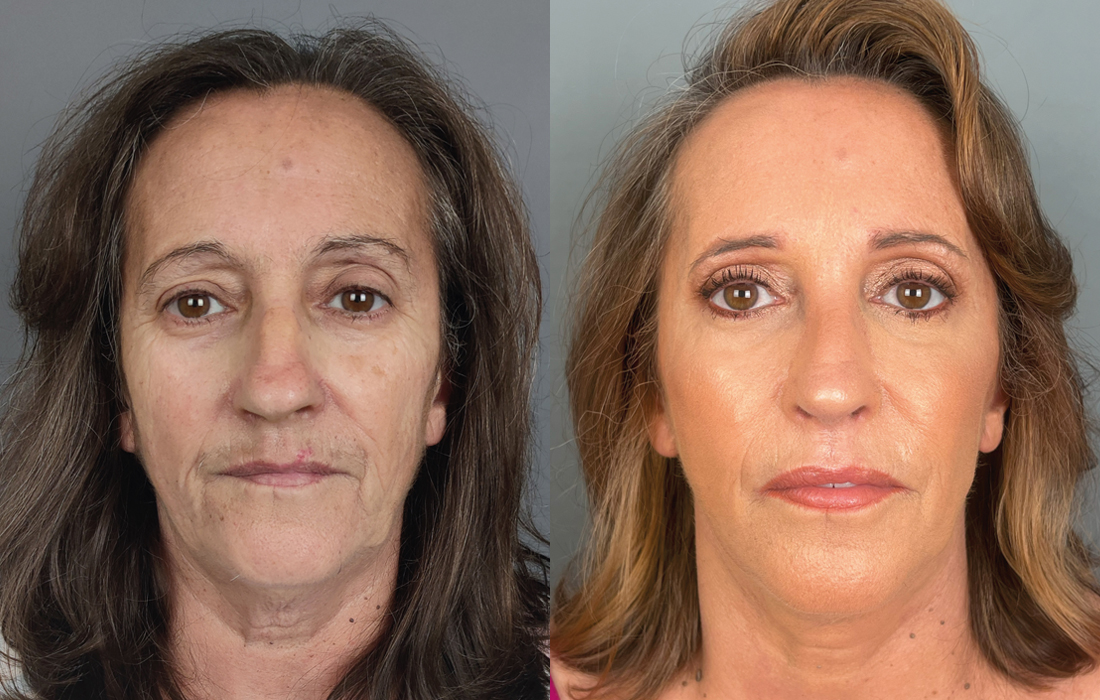 Lifting Facial - Tratamentos Faciais Femininos - Clínica FMR