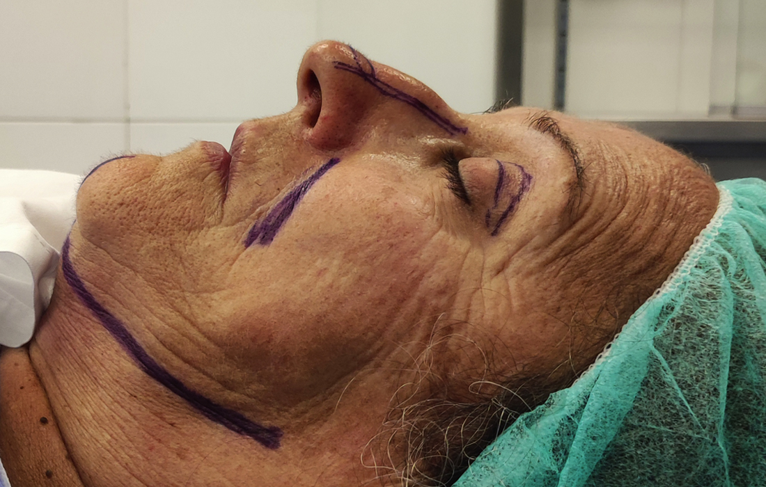 Lifting Facial - Tratamentos Faciais Femininos - Clínica FMR