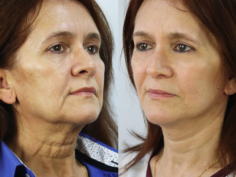 Lifting Facial - Tratamentos Faciais Femininos - Clínica FMR