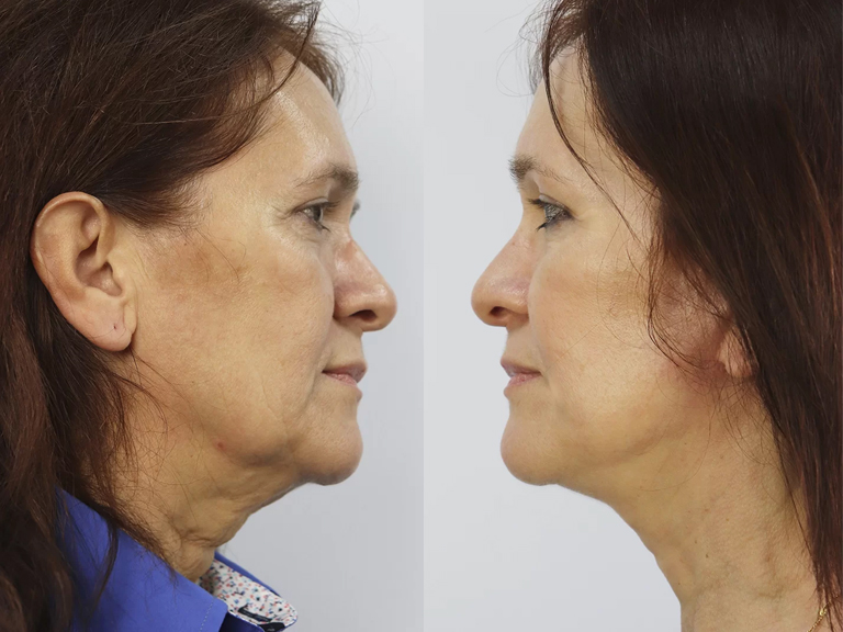 Lifting Facial - Tratamentos Faciais Femininos - Clínica FMR