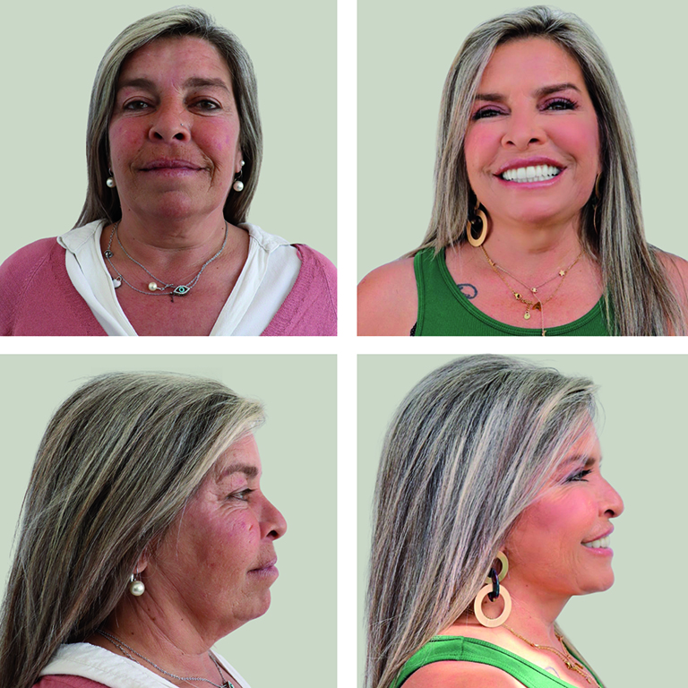 Lifting Facial - Tratamentos Faciais Femininos - Clínica FMR