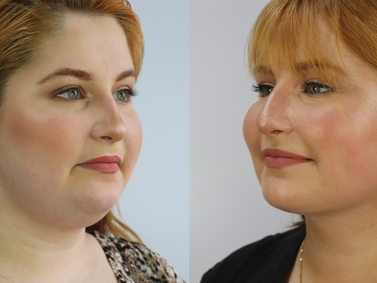 Lipoaspiração do Pescoço - Tratamentos Faciais Femininos - Clínica FMR