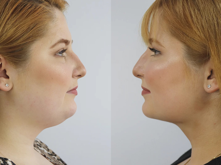 Lipoaspiração do Pescoço - Tratamentos Faciais Femininos - Clínica FMR