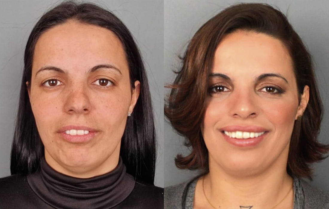 Lipoaspiração do Pescoço - Tratamentos Faciais Femininos - Clínica FMR