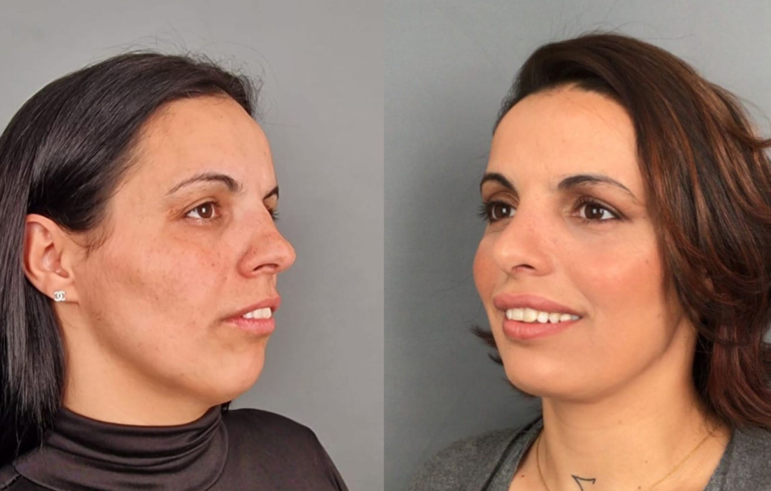 Lipoaspiração do Pescoço - Tratamentos Faciais Femininos - Clínica FMR