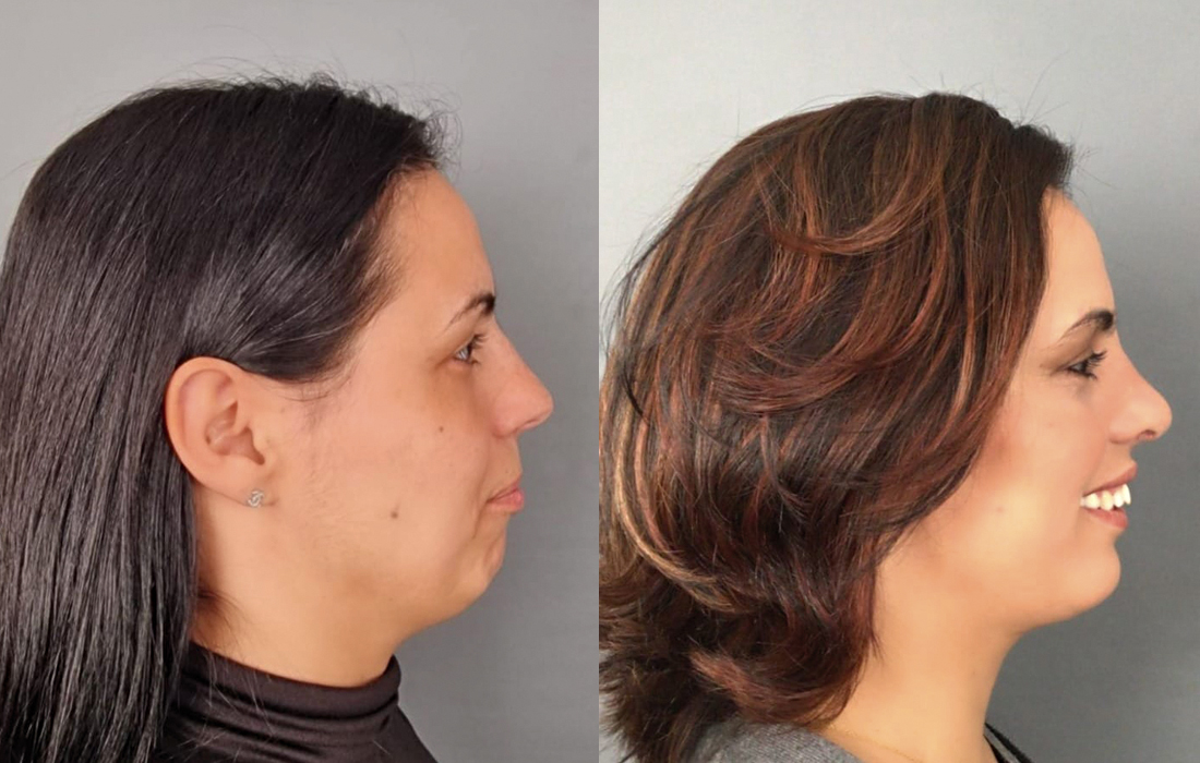 Lipoaspiração do Pescoço - Tratamentos Faciais Femininos - Clínica FMR
