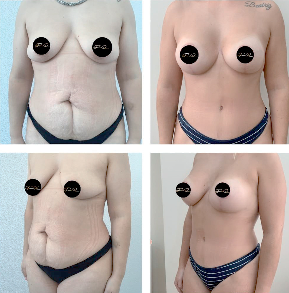 My Bodyback - Cirurgias Combinadas - Clínica FMR