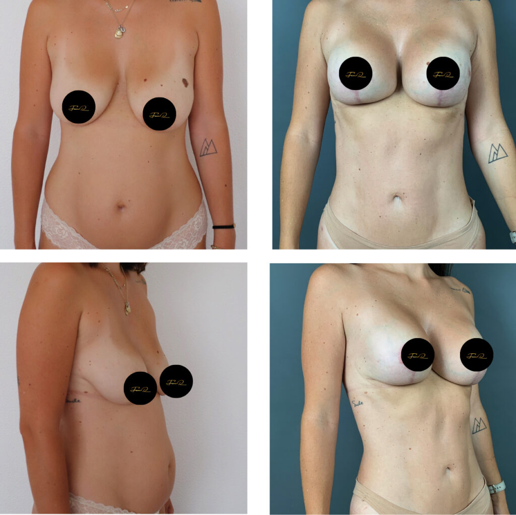 My Bodyback - Cirurgias Combinadas - Clínica FMR