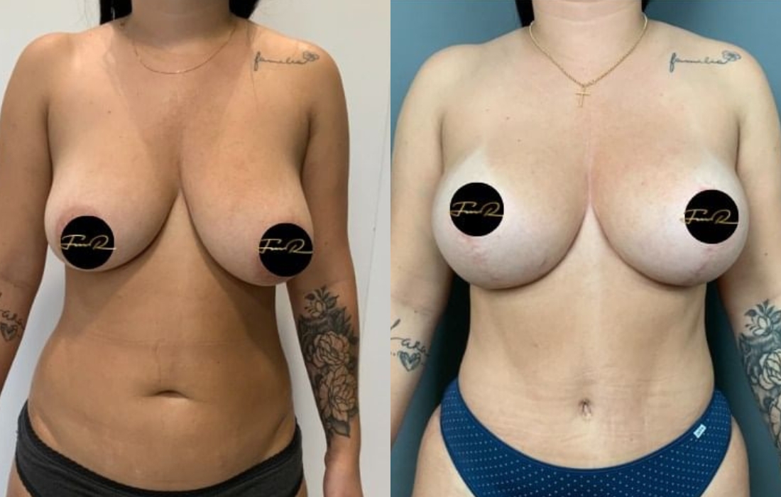 My Bodyback - Cirurgias Combinadas - Clínica FMR