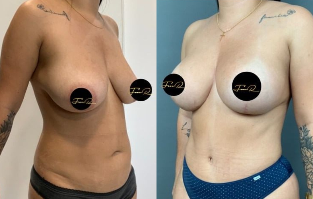 My Bodyback - Cirurgias Combinadas - Clínica FMR