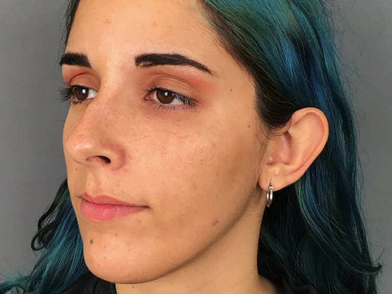 Otoplastia - Tratamentos Faciais Femininos - Clínica FMR