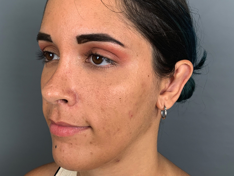Otoplastia - Tratamentos Faciais Femininos - Clínica FMR