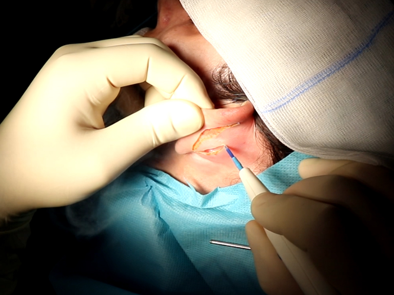 Otoplastia - Tratamentos Faciais Femininos - Clínica FMR