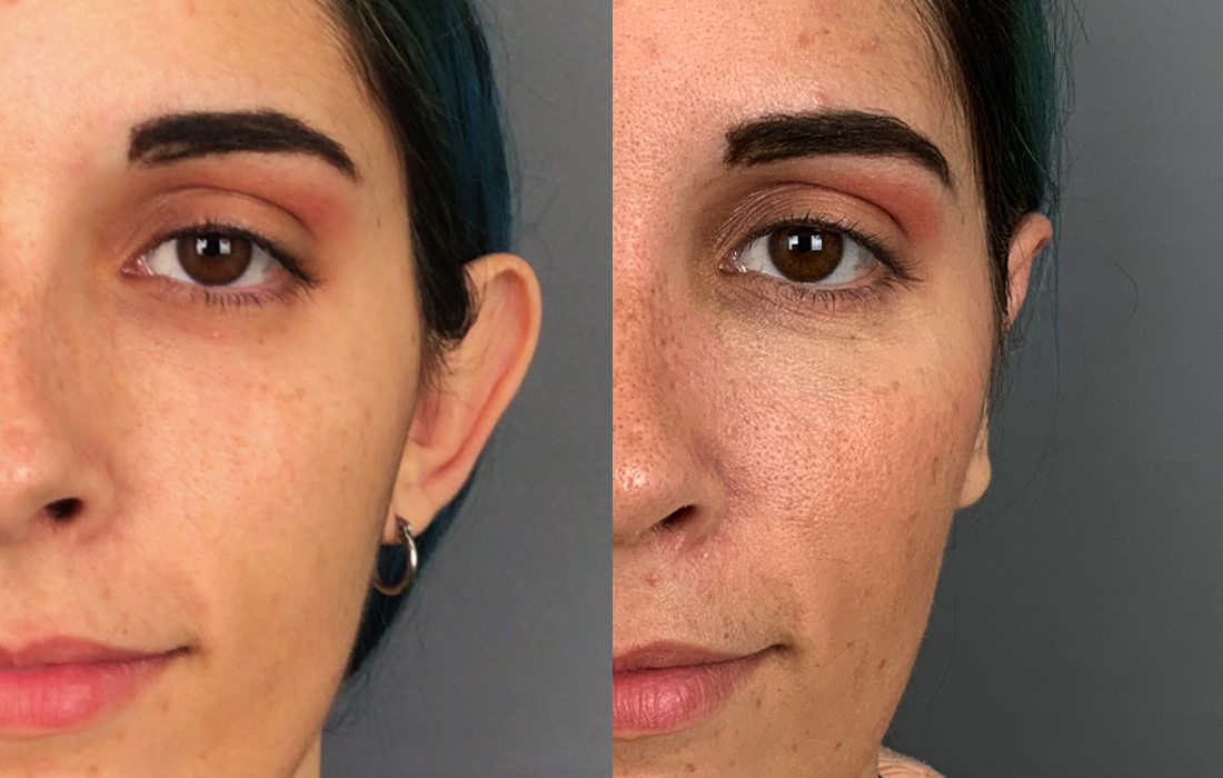 Otoplastia - Tratamentos Faciais Femininos - Clínica FMR