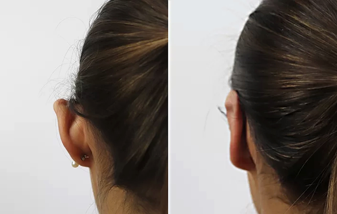 Otoplastia - Tratamentos Faciais Femininos - Clínica FMR