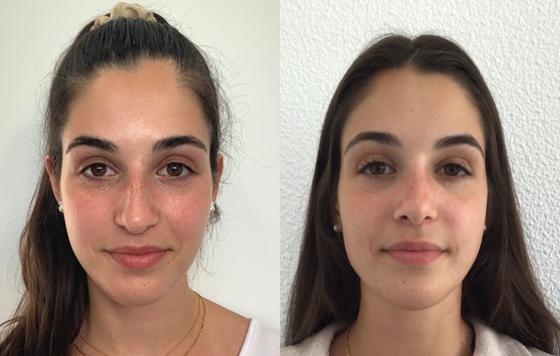 Caso Clínico Rinosseptoplastia - Clínica FMR