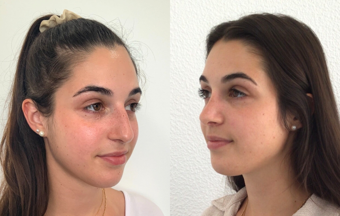 Caso Clínico Rinosseptoplastia - Clínica FMR