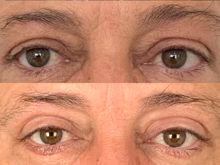 Blefaroplastia - Tratamentos Faciais Masculinos - Clínica FMR