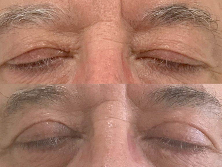 Blefaroplastia - Tratamentos Faciais Masculinos - Clínica FMR