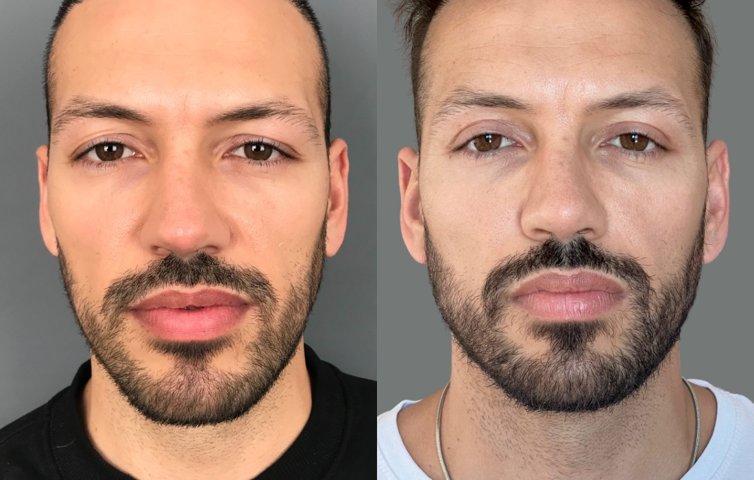 Blefaroplastia - Tratamentos Faciais Masculinos - Clínica FMR