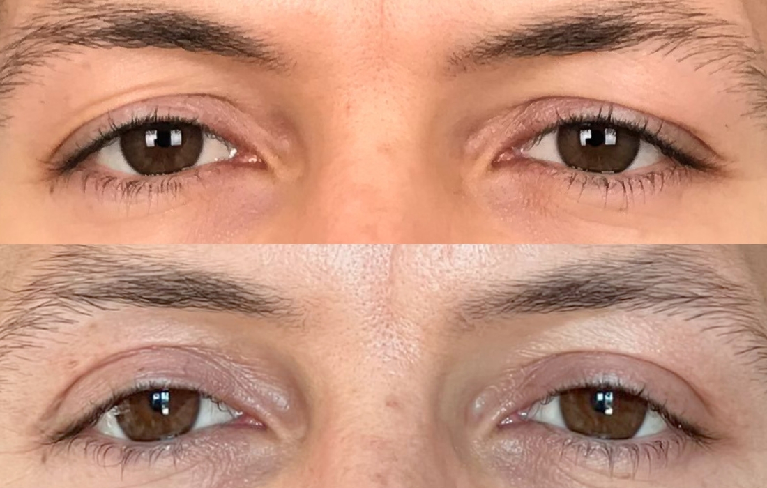 Blefaroplastia - Tratamentos Faciais Masculinos - Clínica FMR