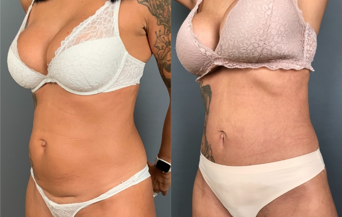 Caso 10_Abdomino 45º - 54095