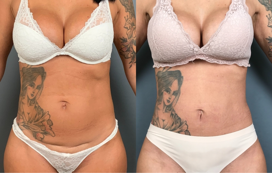 Caso 10_Abdomino Frente - 54095