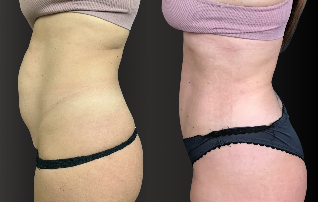 18890 Mini Abdominoplastia lado