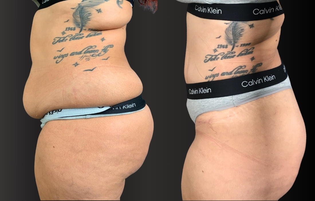 52967 Abdominoplastia 45º (2)